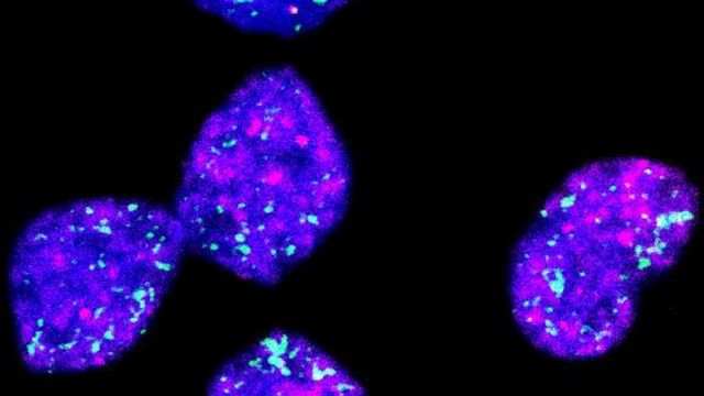 Fluorescent microscopy image of neuroblastoma cells showing bright blue, pink, and green markers against a black background. 