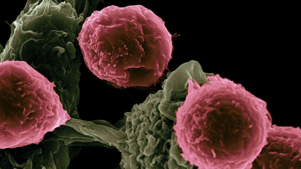 Red cells on yellowed structure. Scanning electron microscope image of cancer.