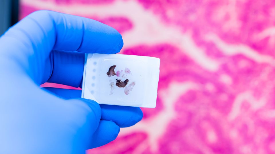 A gloved hand holding a small sample of formalin-fixed, paraffin-embedded (FFPE) tissue, with a magnified image of pink tissue in the background.