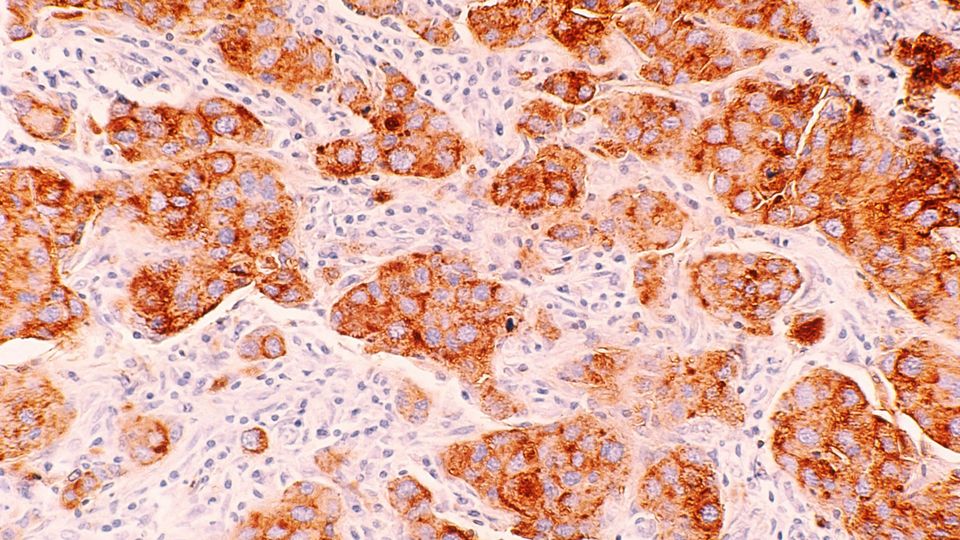 Breast cancer cells, colorized in dark orange and light pink.