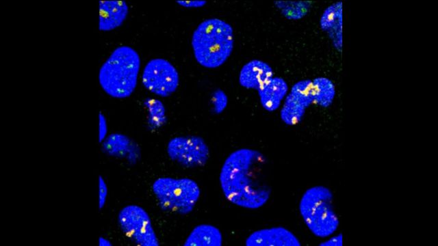 Nuclear speckles merge with chromatin in a colorized microscopy image, illustrating a potential target for neurodegenerative diseases. 